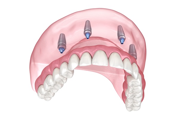 All On  ® Vs  Dental Bridges Vs  Traditional Dentures