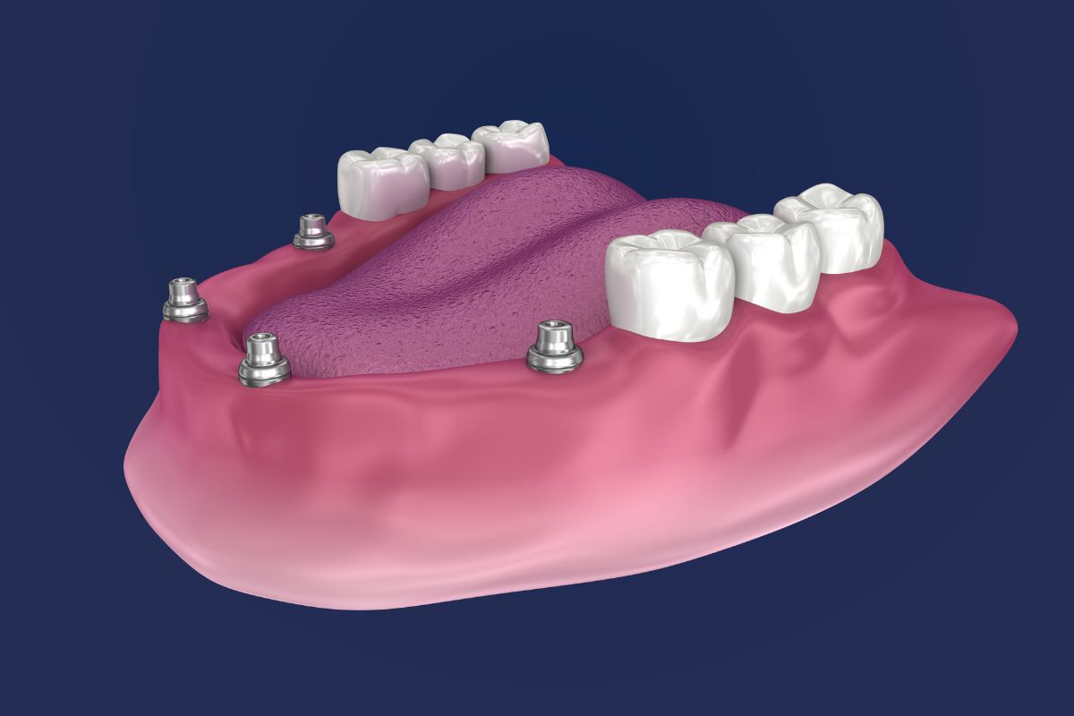 all on 4 implants silverdale