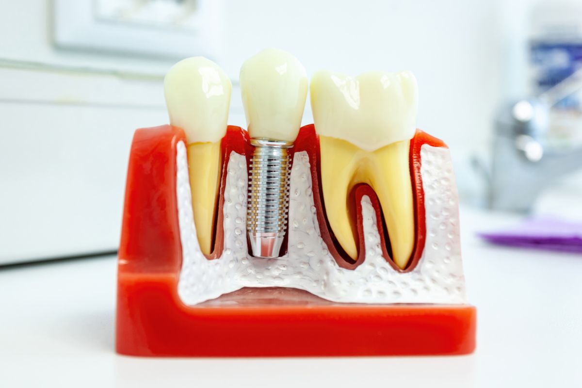 dental implants in silverdale