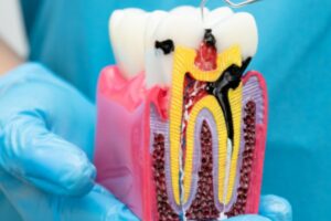 Infected tooth cross-section with root canal
