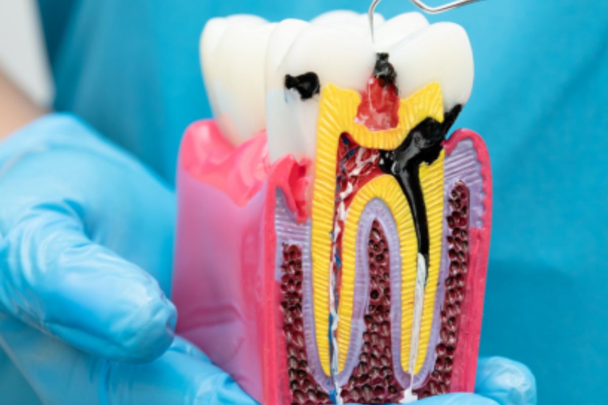 Infected tooth cross-section with root canal