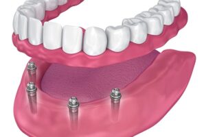 all on 4 dental implants in silverdale