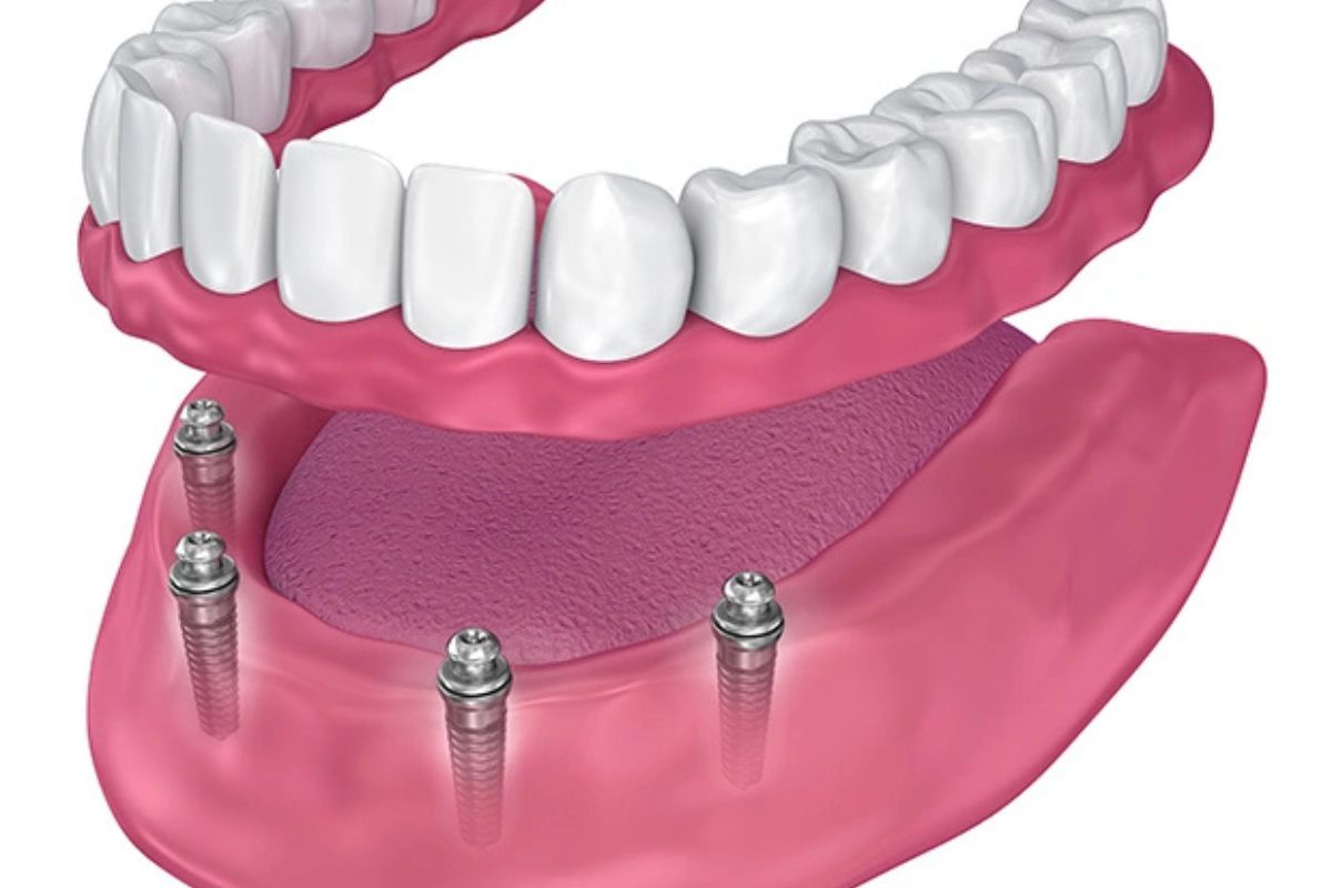 all on 4 dental implants in silverdale