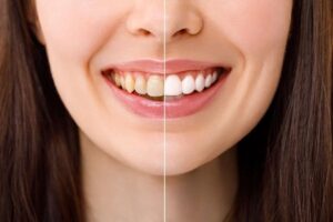 Before and after comparison of teeth whitening treatment results