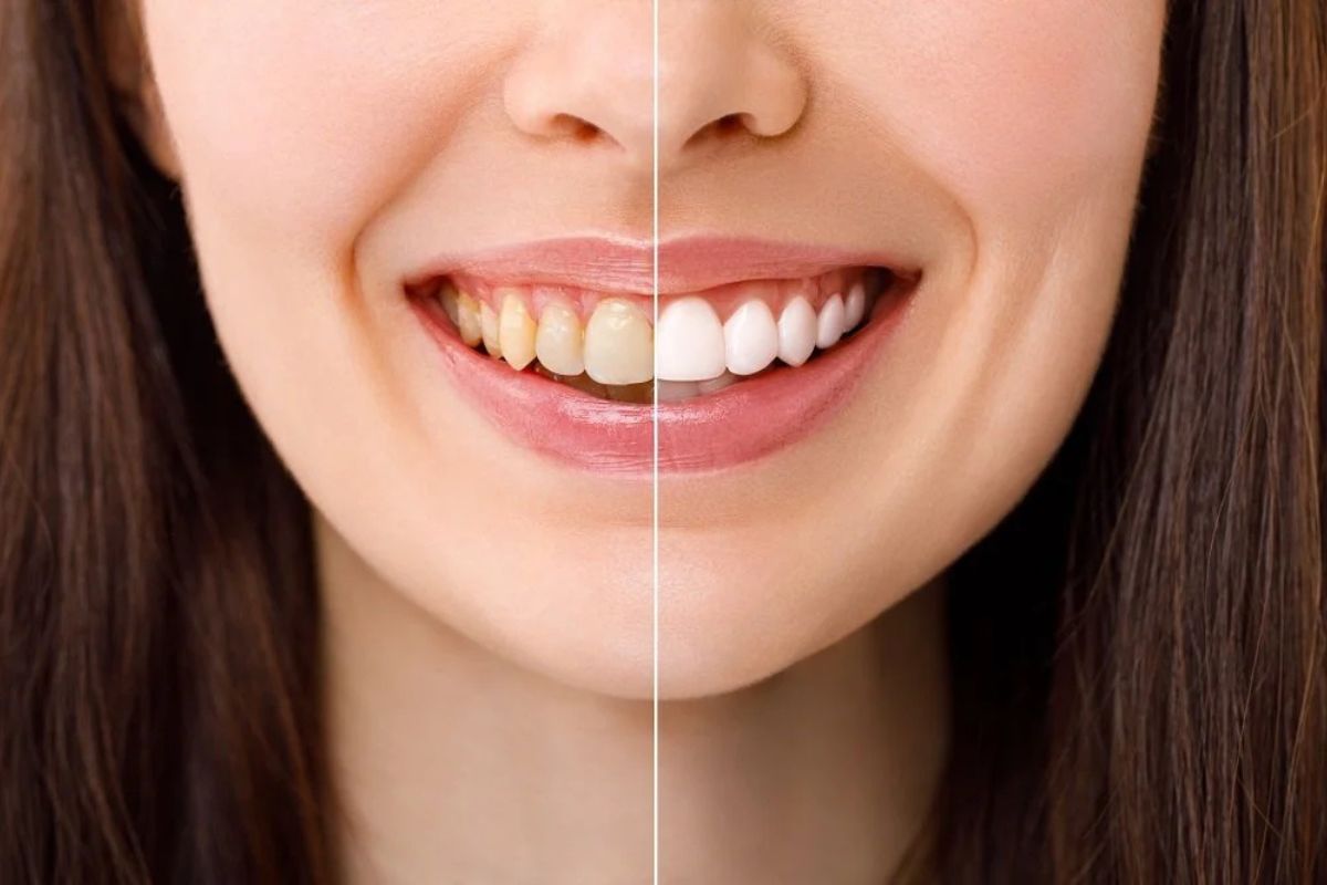 Before and after comparison of teeth whitening treatment results
