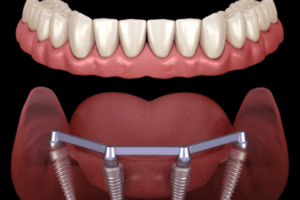 All-on-4 dental implants diagram showing prosthetic teeth on implant posts in jawbone.