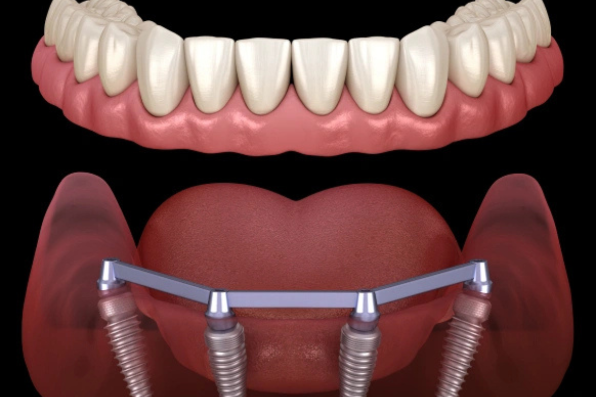 Dentist in Silverdale evaluating a patient for All-on-4 dental implants