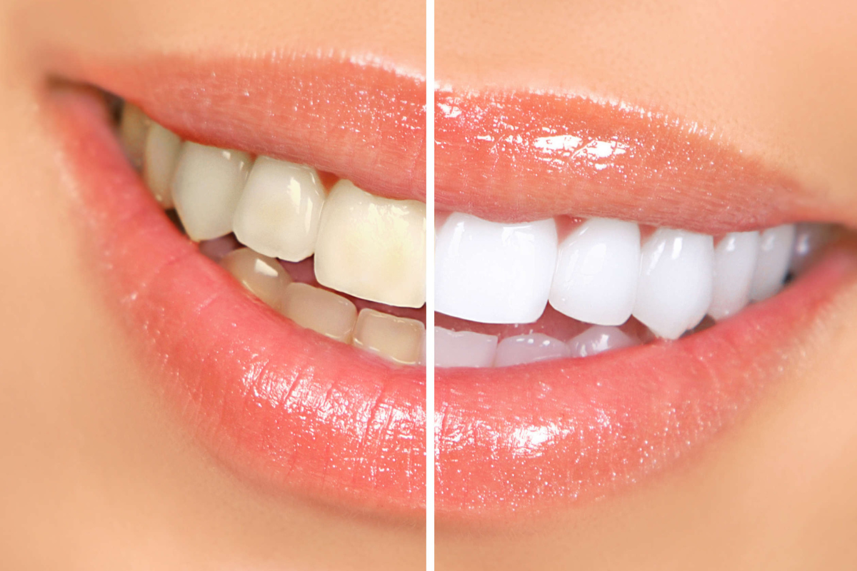 Silverdale dentist discussing professional teeth whitening with a patient