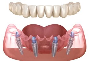 Dental implant illustration showing prosthetic teeth and four titanium implants in jawbone for All on 4 treatment.