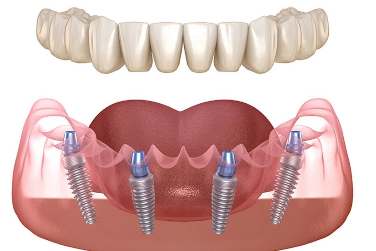 Dental implant illustration showing prosthetic teeth and four titanium implants in jawbone for All on 4 treatment.