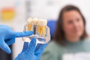 Single dental implant demo showing missing tooth replacement in Silverdale, WA