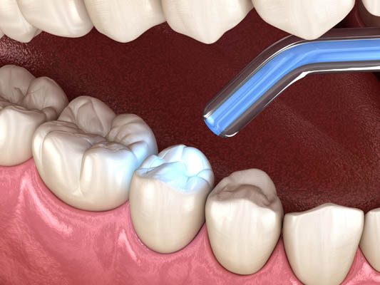 Can Dental Fillings Treat Tooth Decay?
