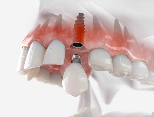 Dental Implant Silverdale, WA