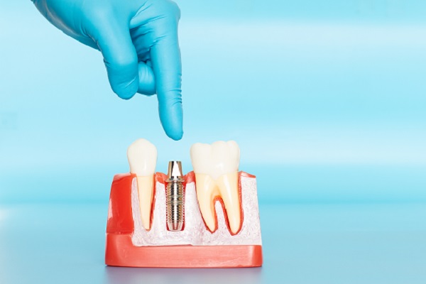 Reasons To Choose Dental Implants For Missing Tooth Replacement