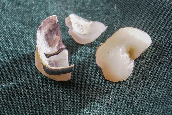 Tooth Filling vs. Dental Inlay - Clear Creek Dentistry Silverdale Washington