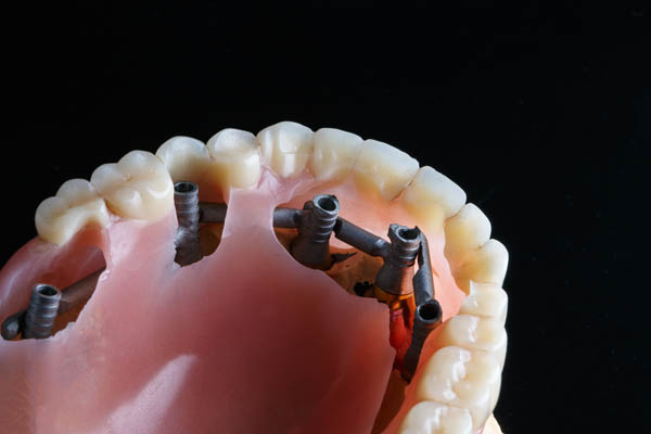Implant Supported Dentures Silverdale, WA